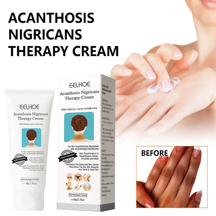 Acanthosis Nigricans Therapy Cream