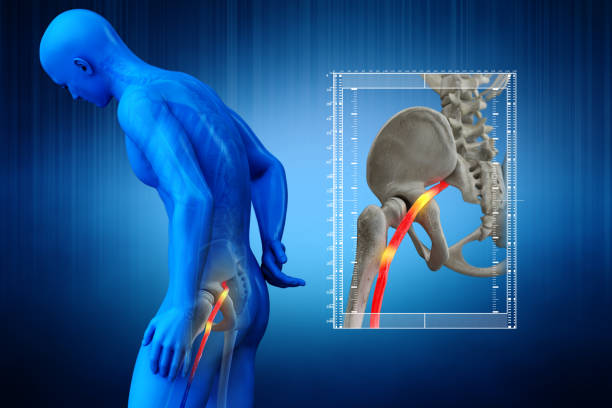2,800+ Sciatica Stock Photos, Pictures & Royalty-Free Images - iStock |  Sciatic nerve, Back pain, Herniated disc