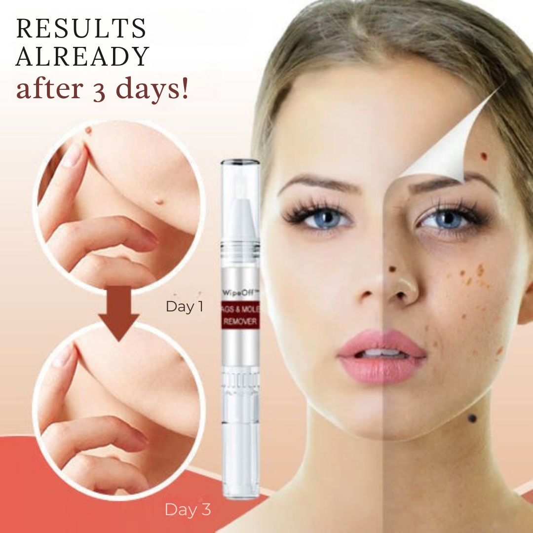 ✨ 50% off flash sale |  Tags & Mole Remover