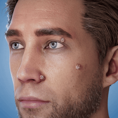 Yunpso™ MicroNeedle Botanic Skin Tag Removal Patch