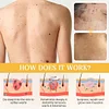 🔥DermaErase Advanced Mole & Spot Removal Gel