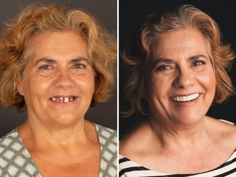 🔥Ends Today: 70% OFF!(Affordable Beauty🧏‍♀️🧏‍♂️)--ROSOPL™ --Advanced Customized Full Denture Set🦷