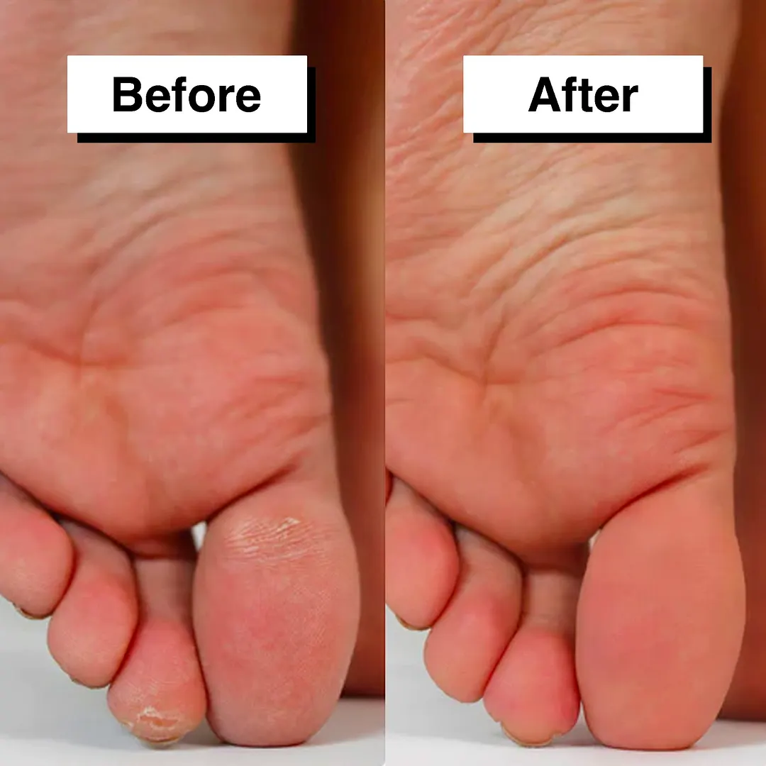 Pedicuure&trade;: Automatic Callus Remover