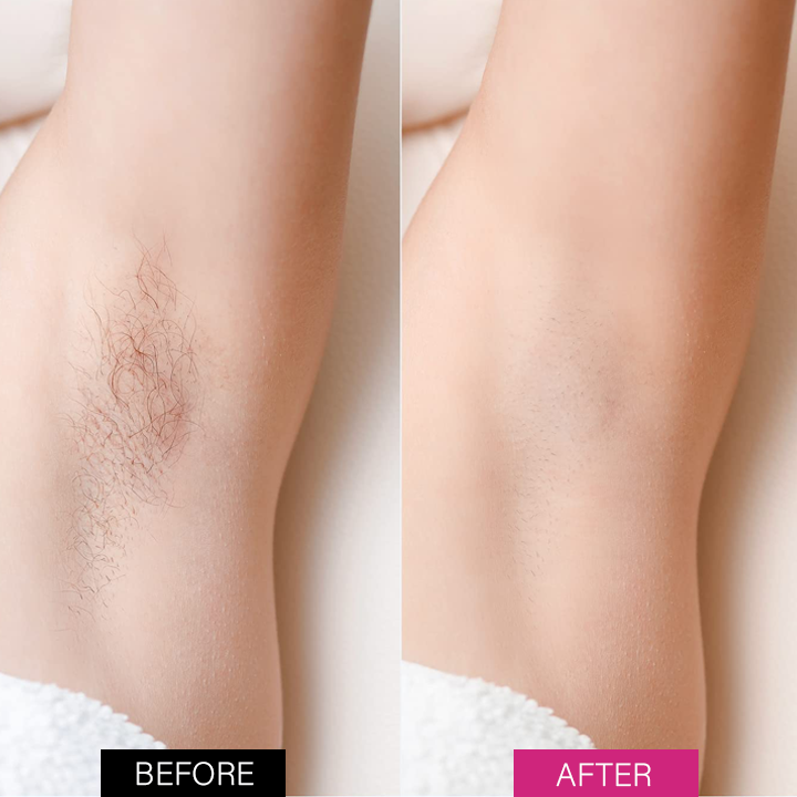 Last Day 49% OFF🔥Hair Removal Mousse