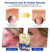 🔥Hot Sale 49% Off🔥PsoriaHeal psoriasis Spray
