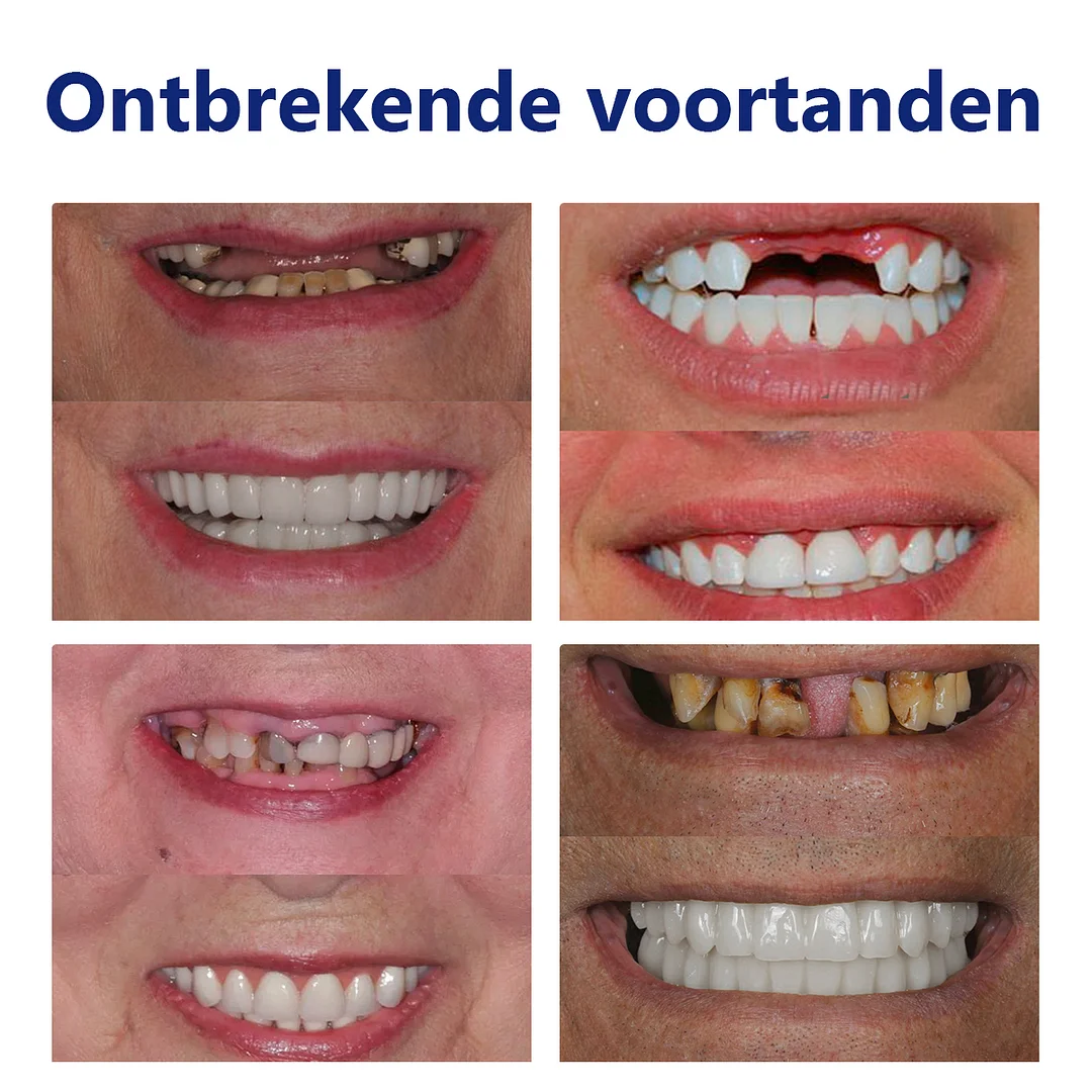 𝐵𝑖𝑘𝑒𝑛𝑑𝑎&trade; Silicium Prothese Meetset🦷（👩&zwj;🔬 Erkend door de Belgische Tandheelkundige Vereniging en goedgekeurd door FAMHP）