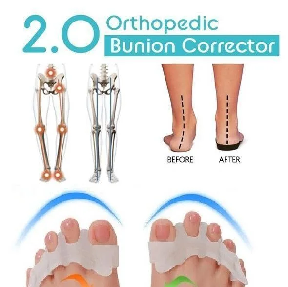 Orthopedic Bunion Corrector 2.0(1 PAIR) QueenFunky
