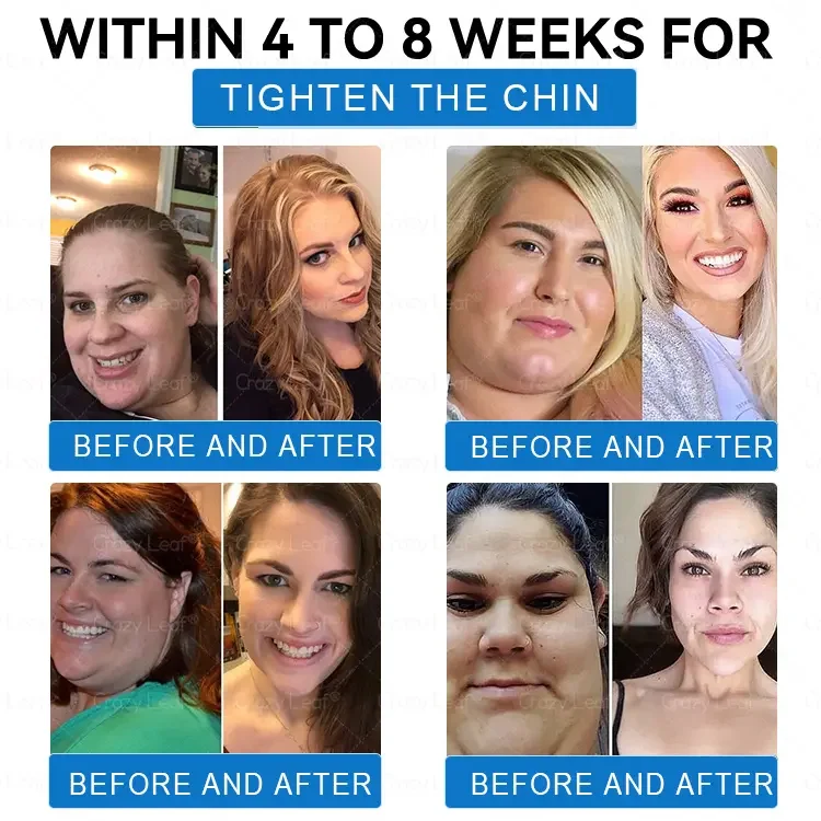 	CrazyLeaf&reg; SMGT-GLP-1 Nano Microneedle Patch