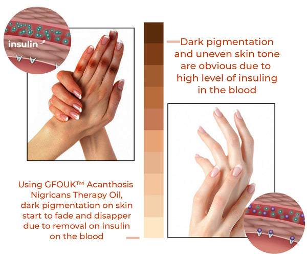 GFOUKTM Acanthosis Nigricans Therapy Oil