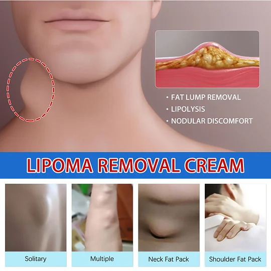 South Moon LumpFree Lipoma Removal Cream