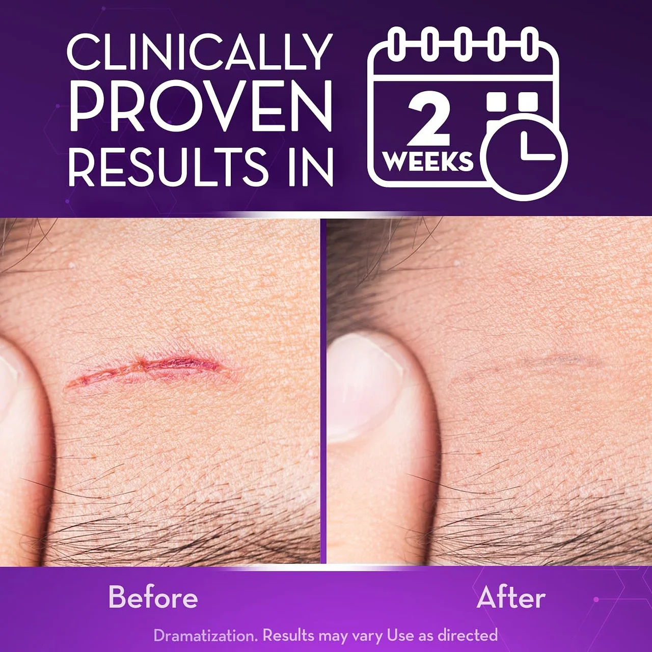 NESLEMY™ Advanced Scar Gel