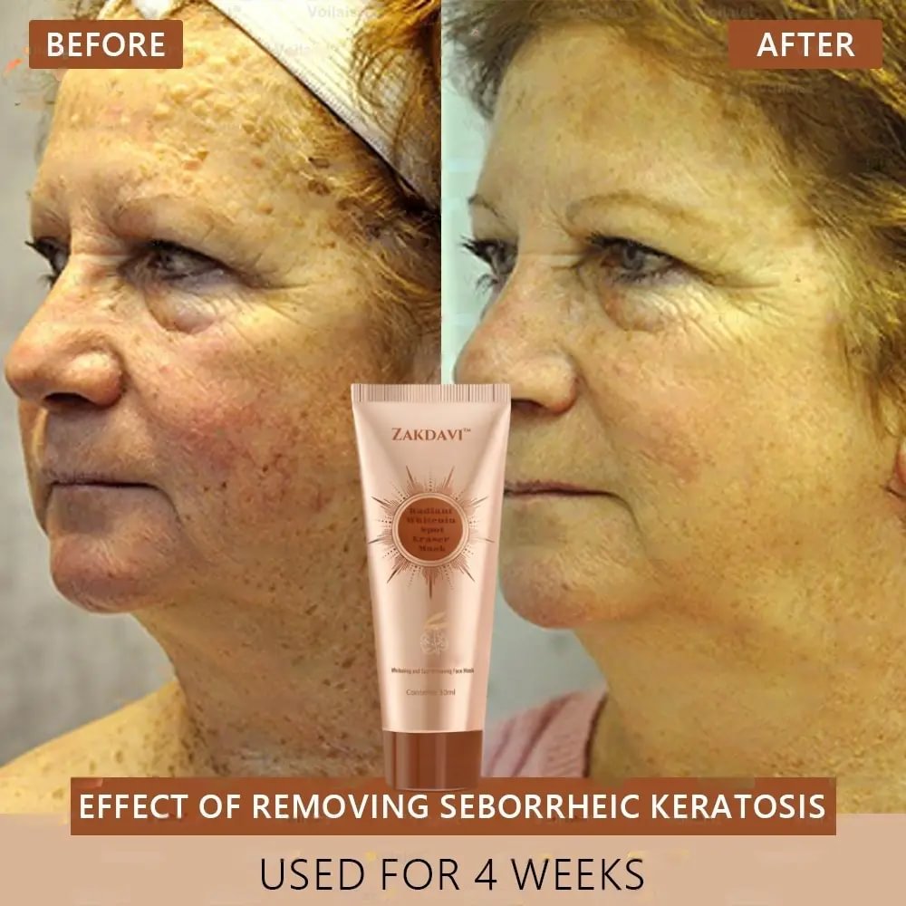 	Zakdavi&trade; Radiant Whitening & Spot Eraser Mask