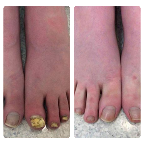 DOCTIA™ BeeVenom FungiVanish Treatment Spray