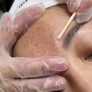 Innovative Anti-Blemish Serum