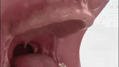 ROSOPL™ Custom-Fit Fully Functional Dentures image ROSOPL™ Custom-Fit Fully Functional Dentures