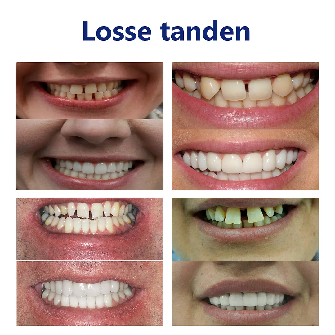 𝐵𝑖𝑘𝑒𝑛𝑑𝑎&trade; Silicium Prothese Meetset🦷（👩&zwj;🔬 Erkend door de Belgische Tandheelkundige Vereniging en goedgekeurd door FAMHP）