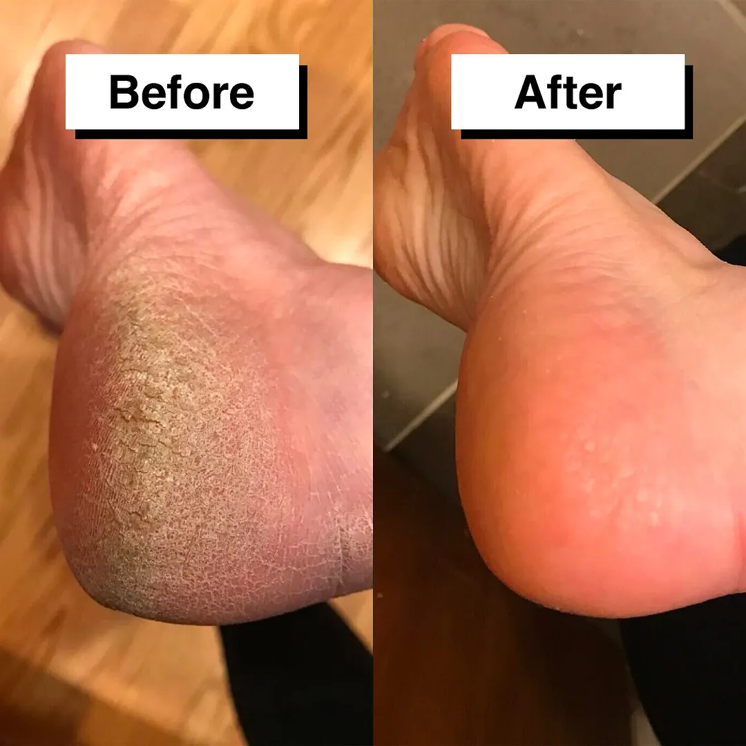 Pedicuure&trade;: Automatic Callus Remover