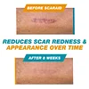 🔥Skin Scar Solutions🛡️ 60% Silicone Scar Stick.