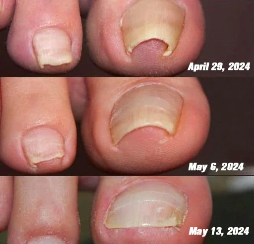 DOCTIA™ Bienen-Gift PilzVanis h Behandlungs spray