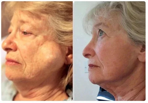 South Moon LumpFree Lipoma Removal Cream