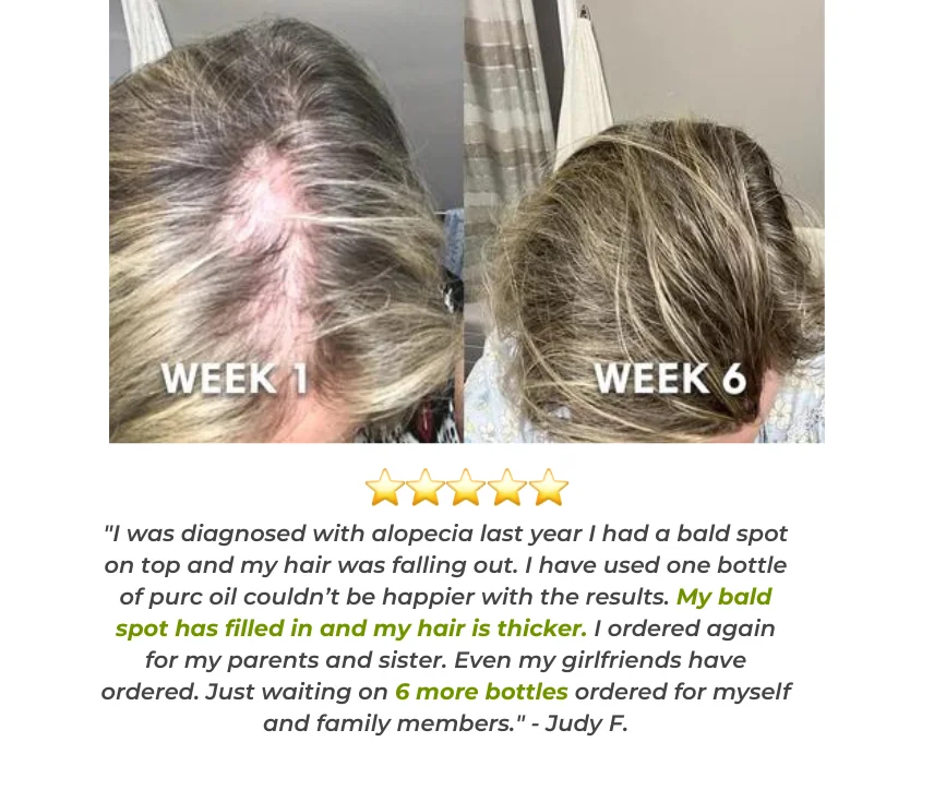 PURC&trade; Hair Growth Essential Oil - Reclaim Your Luscious Locks!