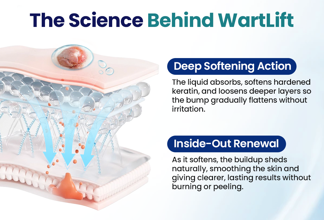 ROSOPL® WartLift Wart Removal Fluid 28 Timilk® WartLift Corn Removal Liquid (A)