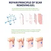 Scar Gel Scar Remover Scar Cream Nourishing Moisturing Gel