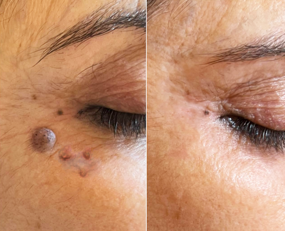 Timilk® WartLift Corn Removal Liquid (A)