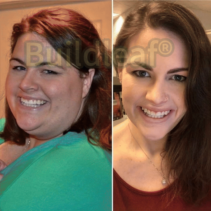 	Buildleaf&reg; SMGT-GLP-1 Nano Microneedle Patch with Collagen Peptides &Matrixyl 3000