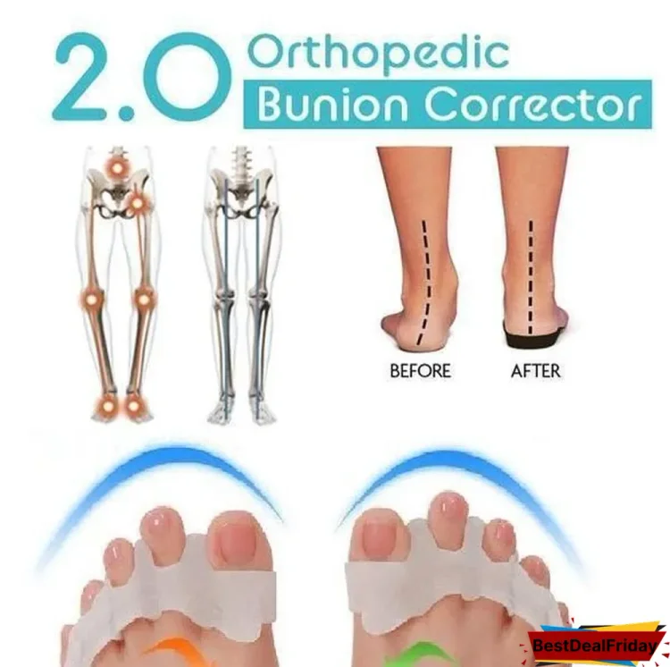 orthopedic bunion corrector 2 0