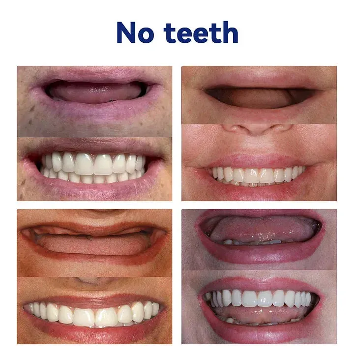 NESLEMY&trade;-🦷Advanced Customized Full Denture Set🦷 (⏰Limited time discount last 30 minutes⏰)