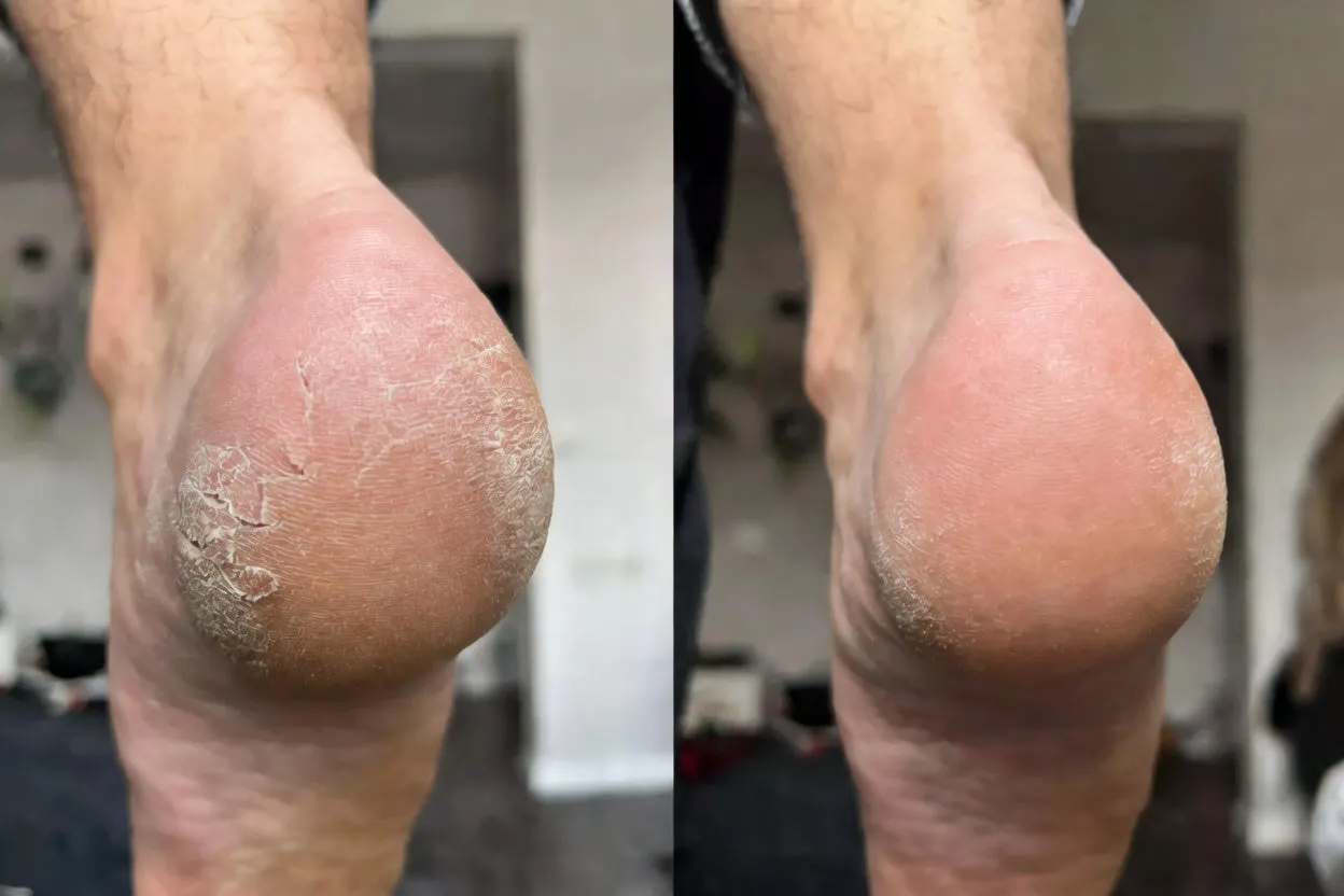 🎁 NEWYUO™ Limited-Time Offer 🎁 - Don't miss out!Tea Tree Oil Foot Cream (Repairs Dry Cracked Heels, Soothes Tired Feet, Eliminates Odor & Restores Soft Skin)
