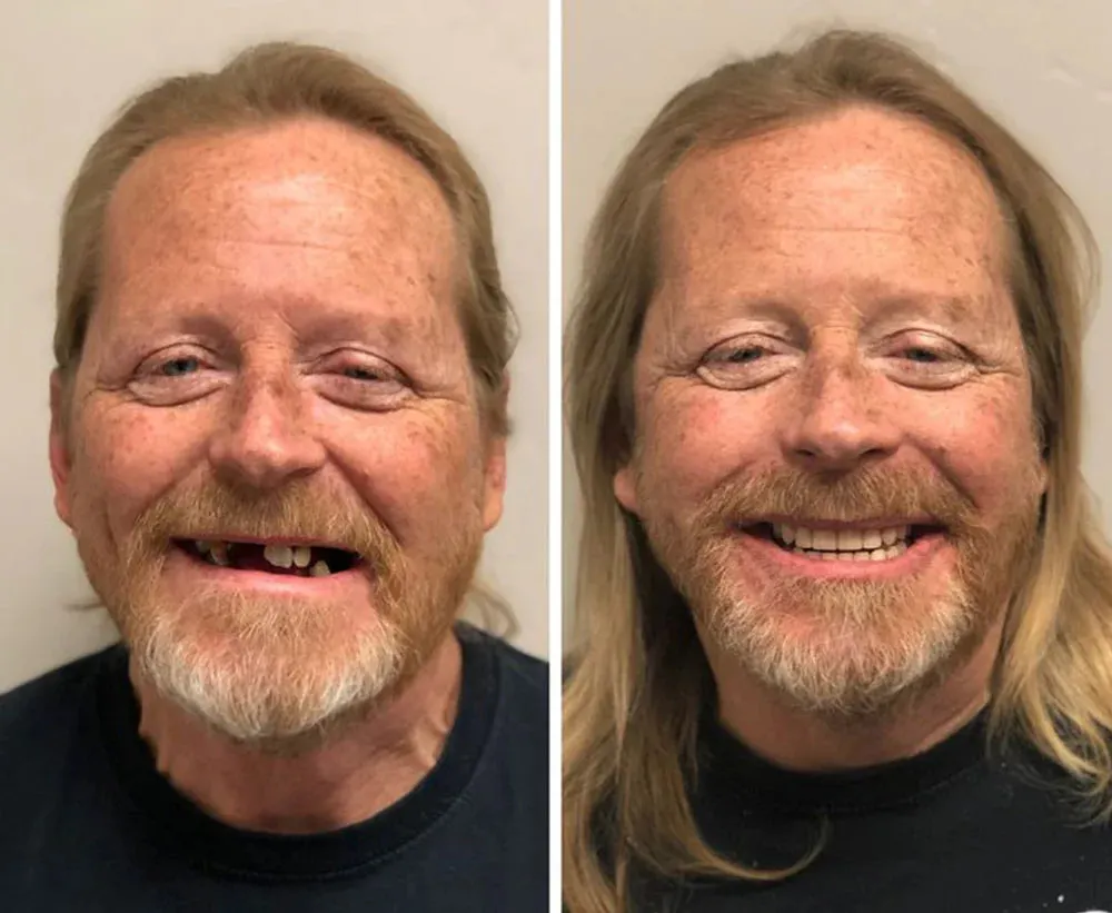 🔥Ends Today: 70% OFF!(Affordable Beauty🧏‍♀️🧏‍♂️)--ROSOPL™ --Advanced Customized Full Denture Set🦷