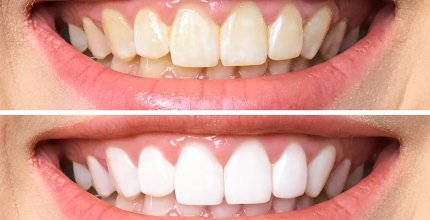 WHAT YOU NEED TO KNOW ABOUT TEETH WHITENING