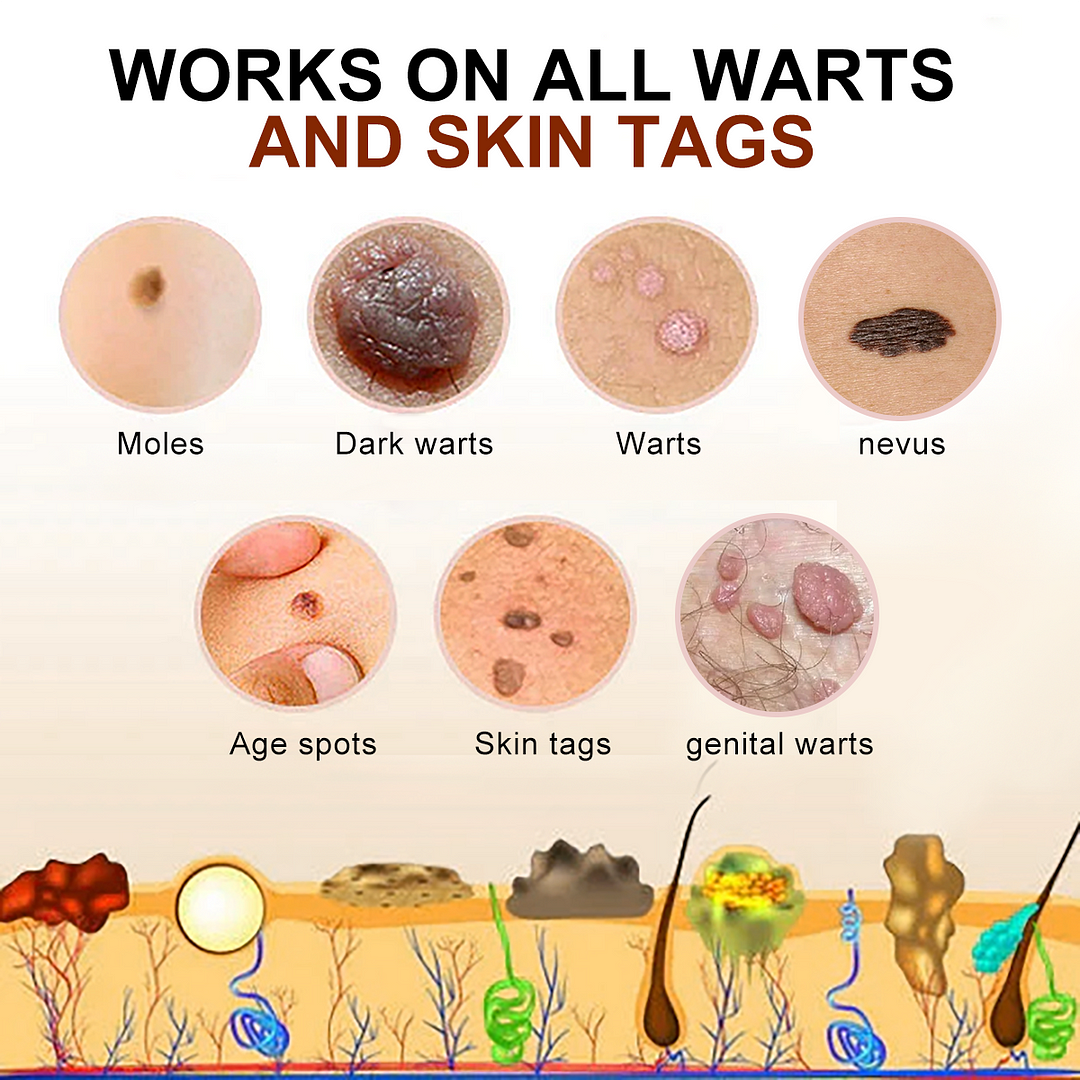 🐝🐝Bee Venom Mole and Wart Treatment Cream