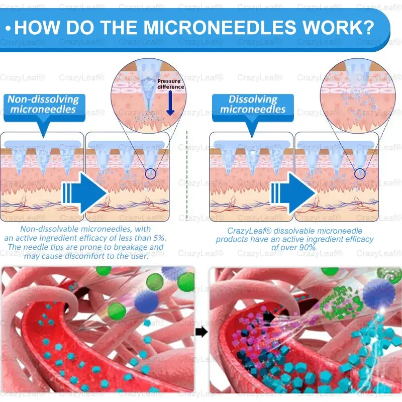 	CrazyLeaf&reg; SMGT-GLP-1 Nano Microneedle Patch
