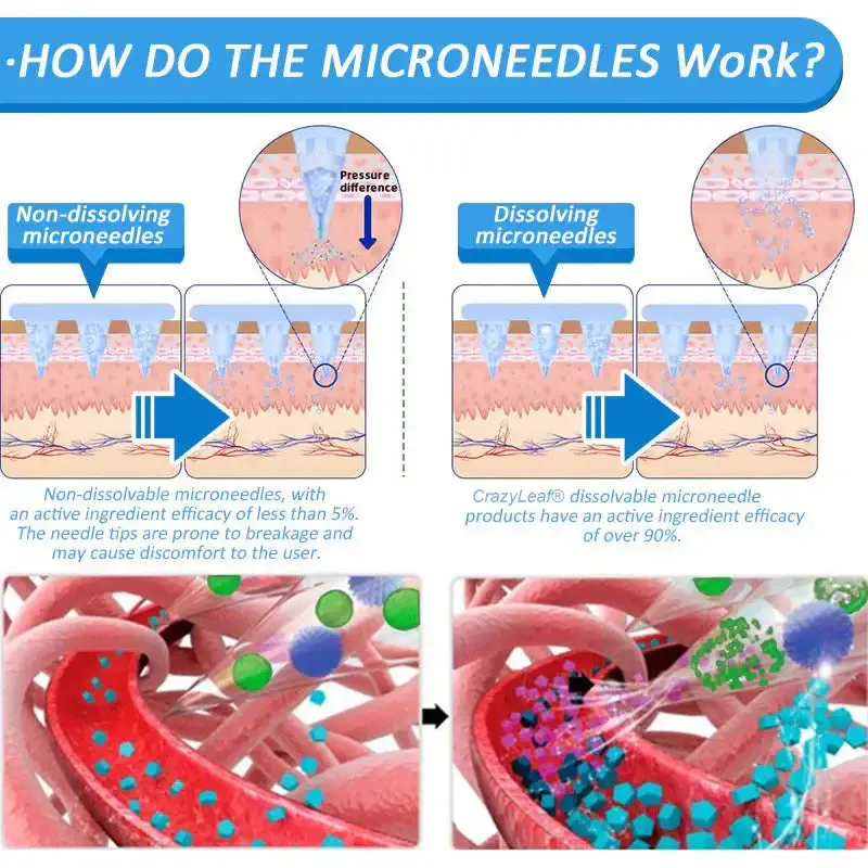 	CrazyLeaf&reg; Nano Microneedle Patch with SMGT-GLP-1