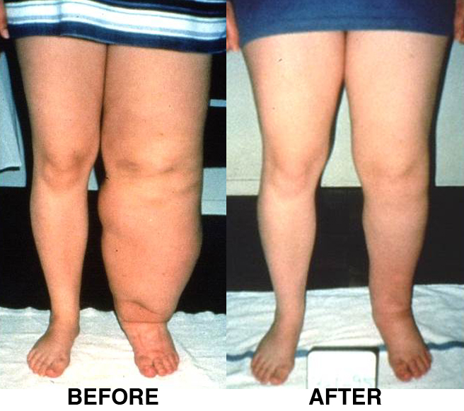About Lymphedema - Klose Training
