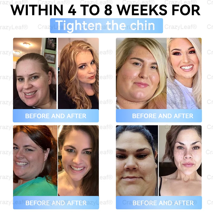 🏥FDA Store | 𝐵uil𝗱𝐿ea𝐟&reg; 𝑺𝑀𝗚T-𝑮𝐋𝑃-1 𝐒limming & 𝐻ealth 𝑁ano 𝑀icroneedle 𝑃atch with Collagen & Matrixyl 3000 丨Obesity,Cardiovascular Diseas, Diabetes, Sleep Apnea, Joint Problems and More