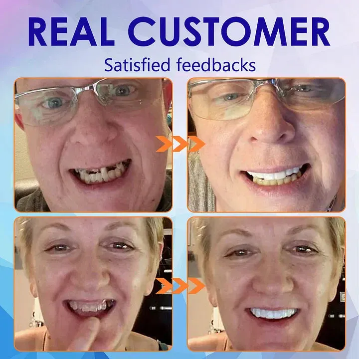 NESLEMY&trade;-🦷Advanced Customized Full Denture Set🦷 (⏰Limited time discount last 30 minutes⏰)