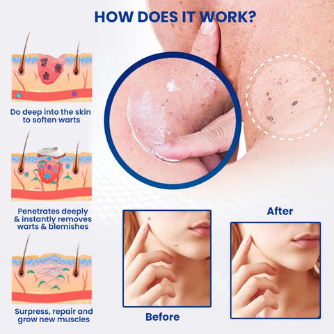 OveallgoTM WartsOff Instant Blemish Removal Cream
