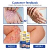 🔥Hot Sale 49% Off🔥PsoriaHeal psoriasis Spray