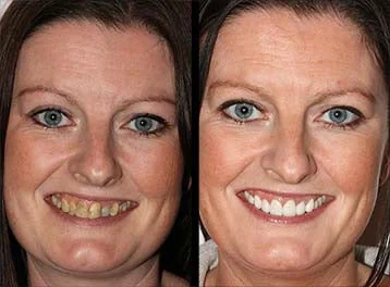 SmileMate™ Removal of tartar and plaque bacteria and various oral problems