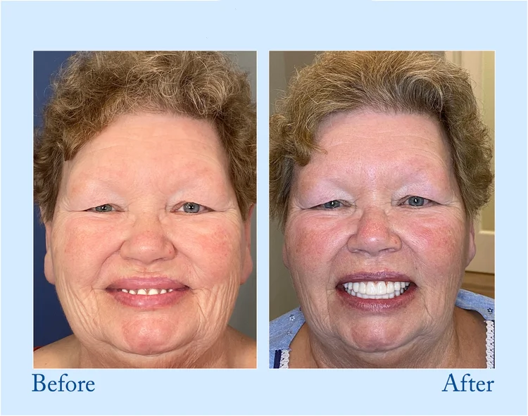 Smileasego - Premium Denture