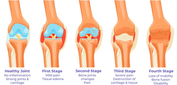 MediCare™ Pro PainRelief Restorative Joint Spray