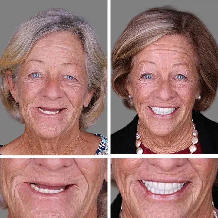 Ends Today: 70% OFF! ⏰ Medical Full Denture with Strong Suctiond🦷Obtain American Dental Association (ADA) Certification
