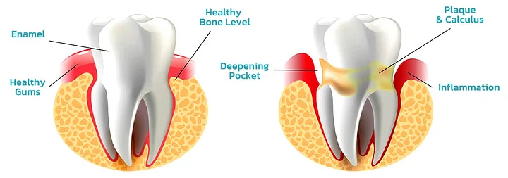 SmileMate™ Removal of tartar and plaque bacteria and various oral problems