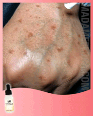Serum organik Suupillid™ për pastrimin e njollave të errëta të lëkurës