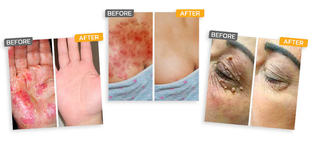 Official Store:LOVILDS® Magnesium Herbal Spray Fast Relief for Psoriasis & Eczema | No-Rub, SteroidFree