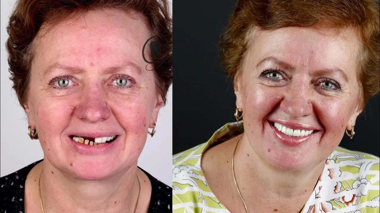 🔥Ends Today: 70% OFF!(Affordable Beauty🧏‍♀️🧏‍♂️)--ROSOPL™ --Advanced Customized Full Denture Set🦷